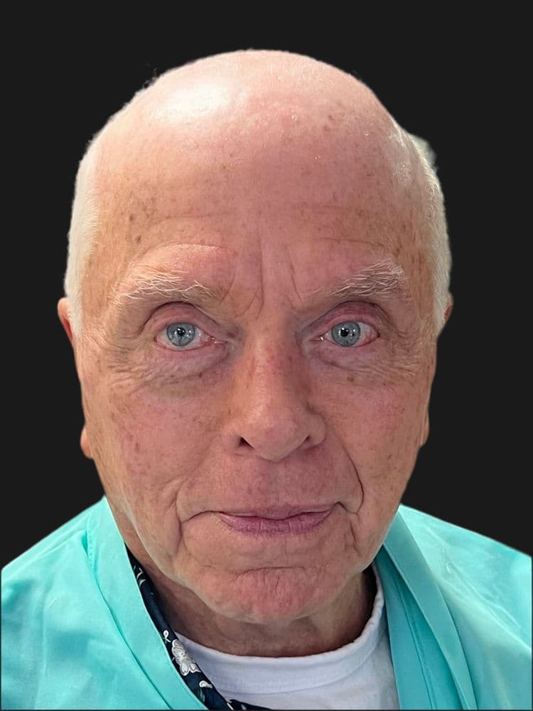 Wigs 401 - hair transplant in Warwick, RI