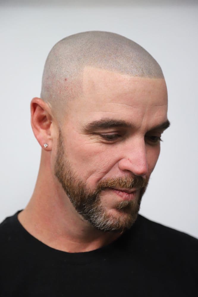 Steady MicroPigmentation - Scottsdale - hair transplant in Scottsdale, AZ