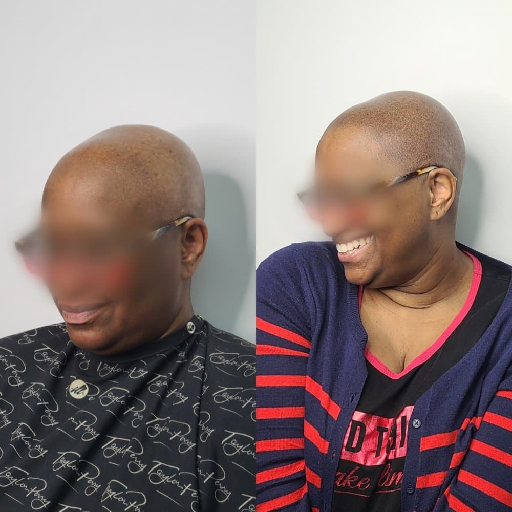 Mel's SMP Studio - hair transplant in Bronx, NY