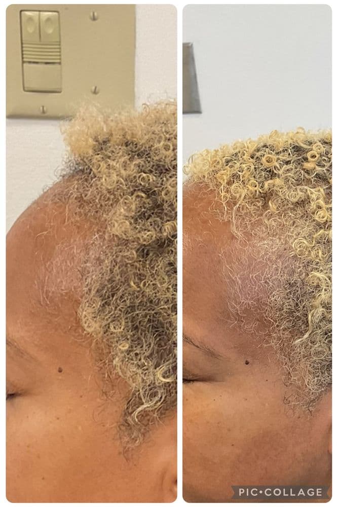 California Aesthetics Hair Restoration and IV Therapy - hair transplant in Glendale, CA