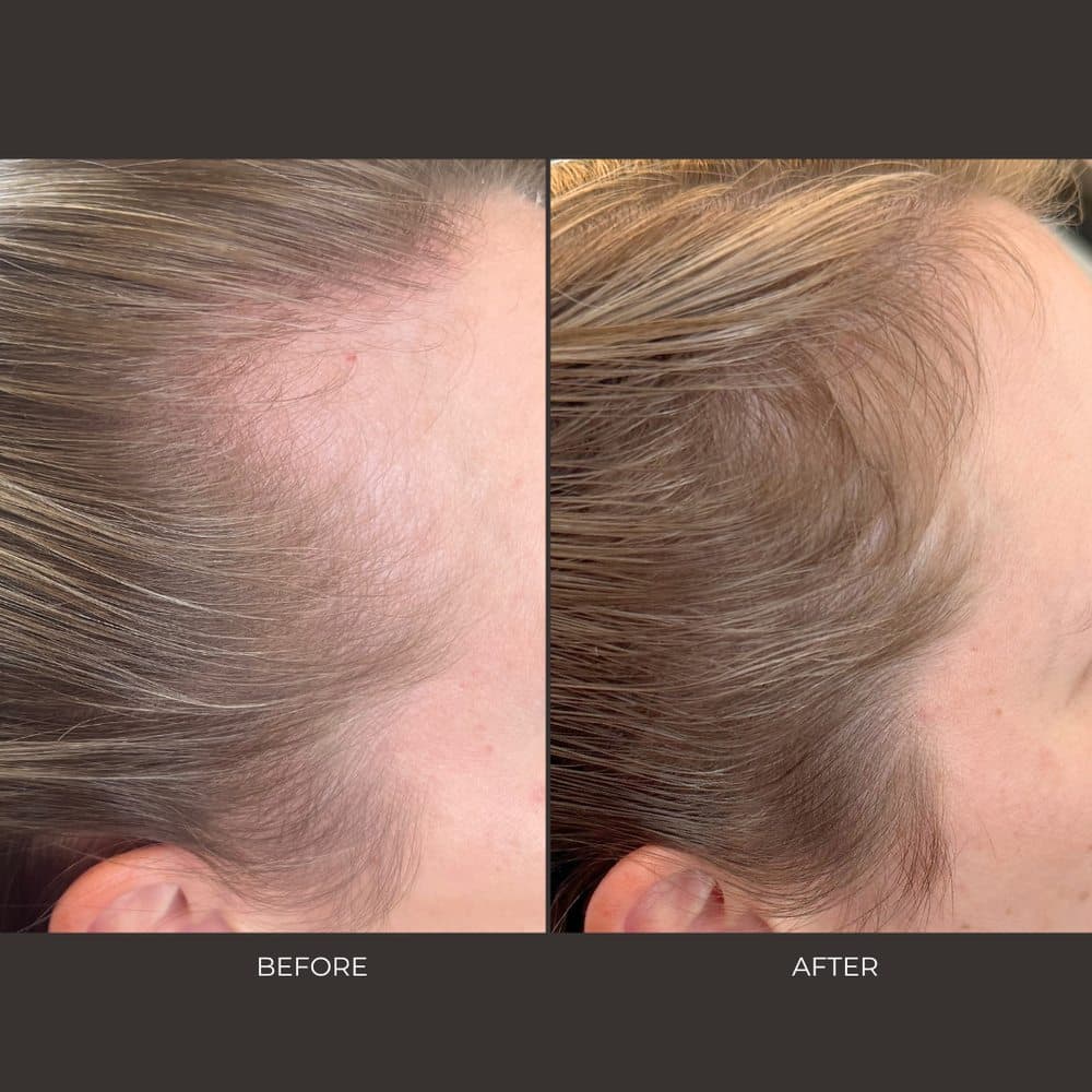 Triangle Trichology - hair transplant in Raleigh, NC