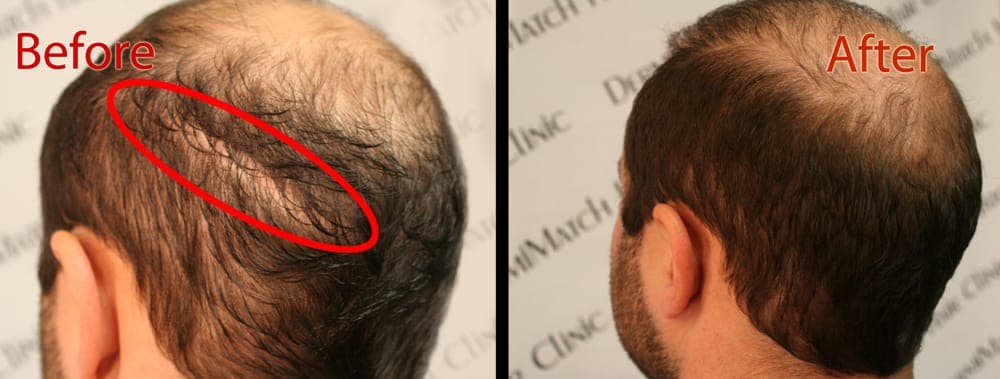 DermiMatch Hair Clinic - hair transplant in Scottsdale, AZ