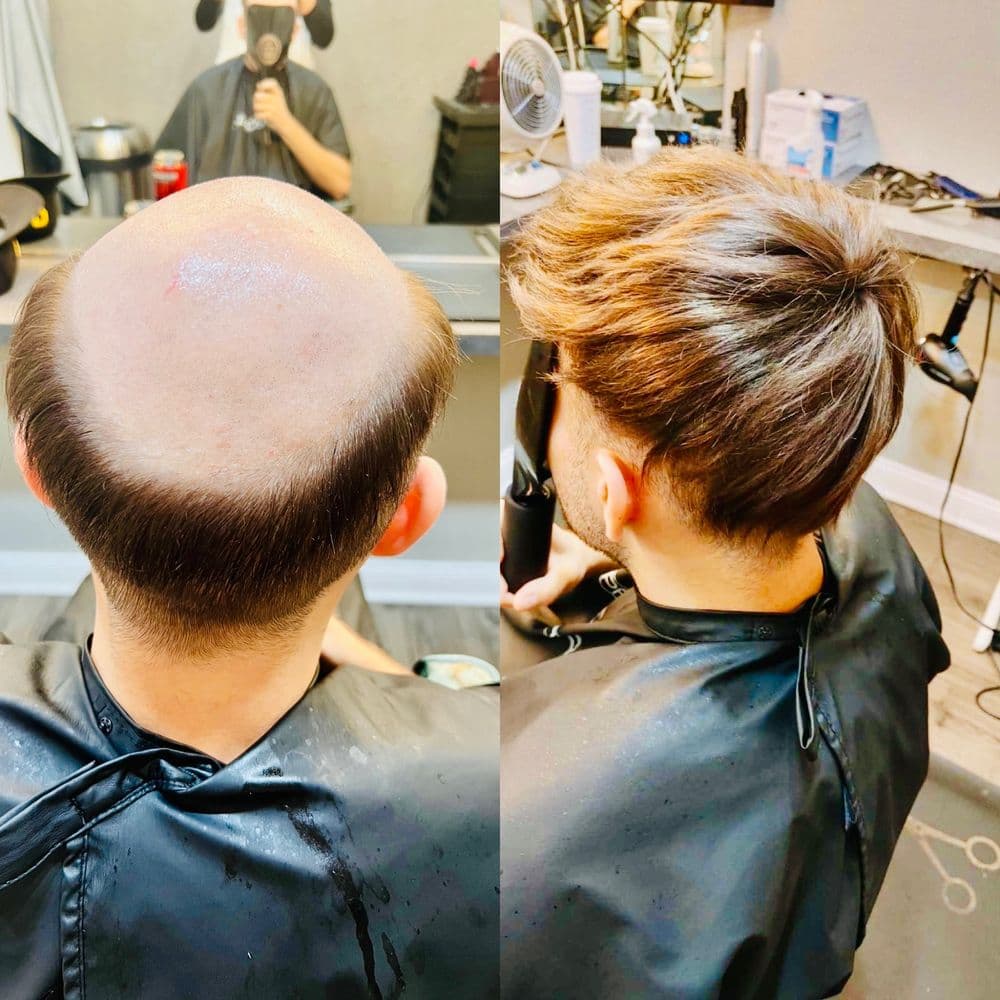 Embassy - hair transplant in Lincolnwood, IL