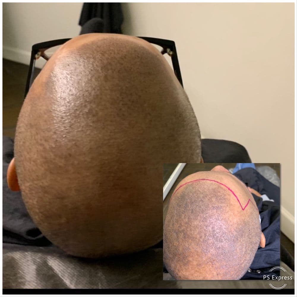 The Hair Simulation Company - hair transplant in Atlanta, GA