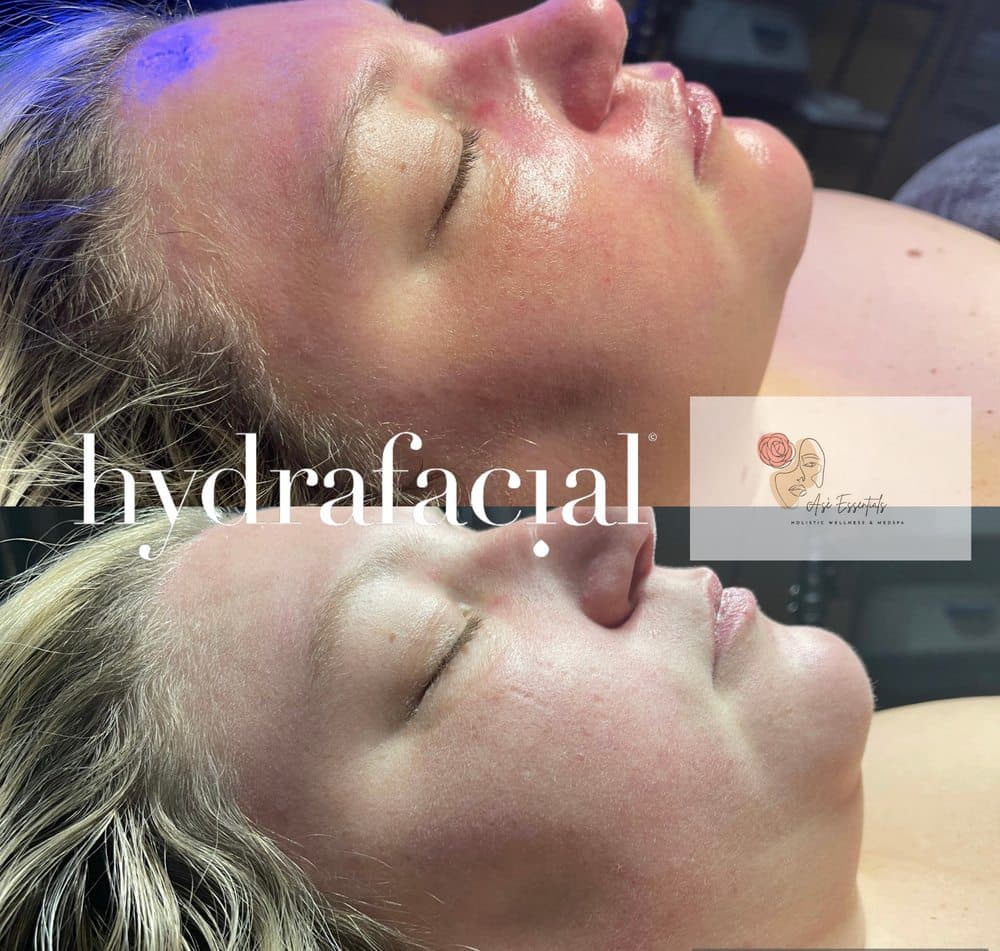 Asé Essentials - hair transplant in Charlotte, NC