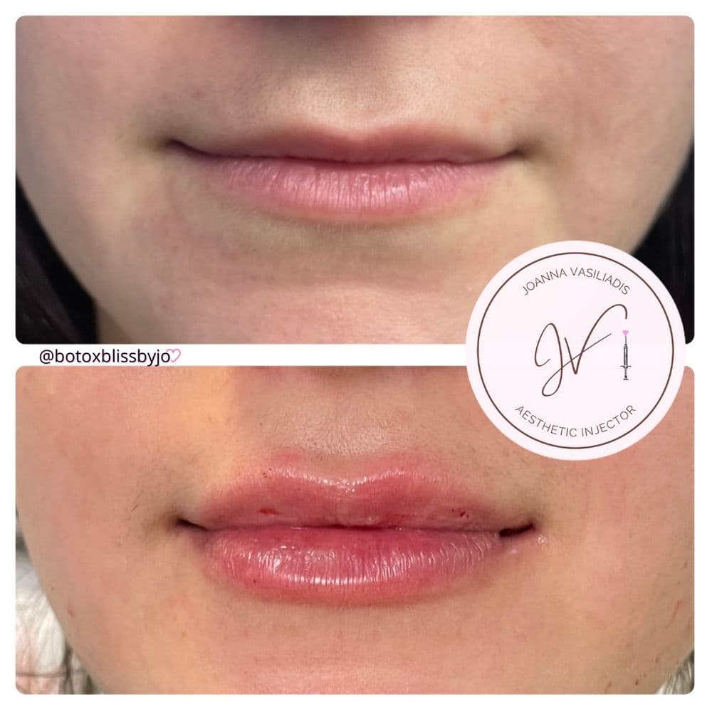 Pure Bliss Aesthetics - hair transplant in Worcester, MA