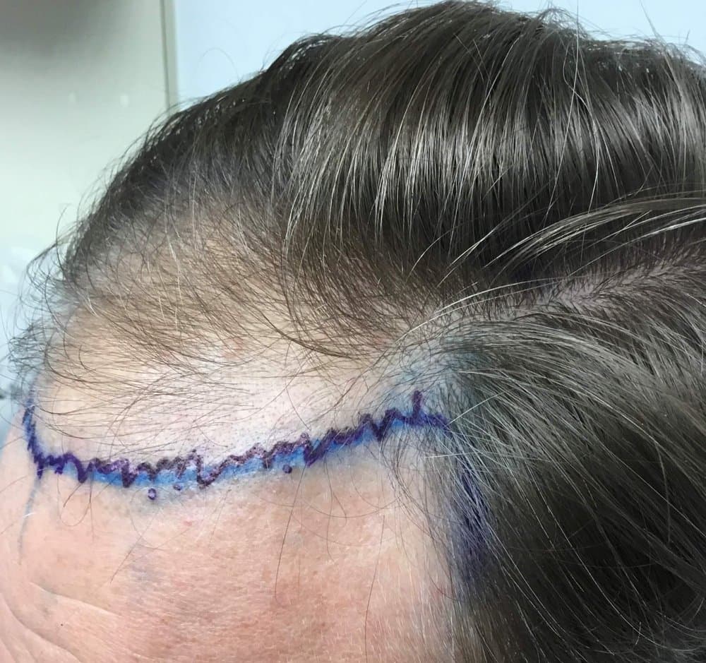 Miami Hair Institute - hair transplant in Coral Gables, FL