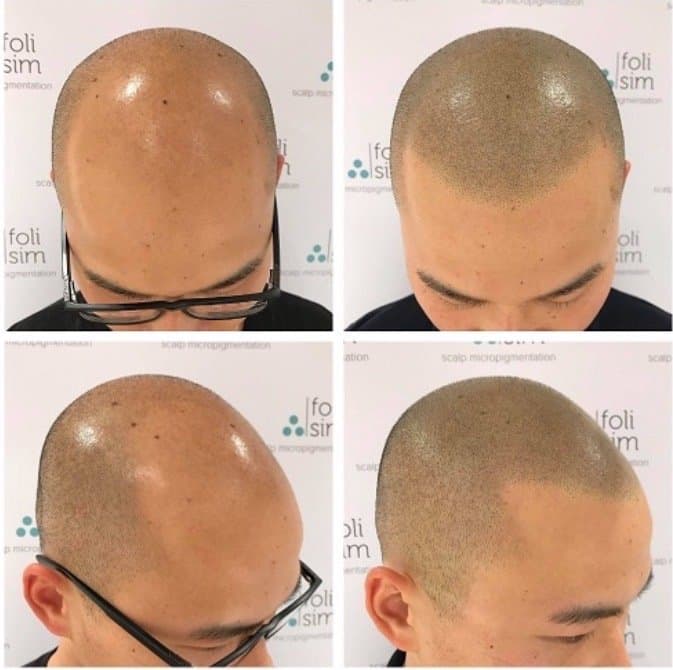Define Smp - Scalp Micropigmentation - hair transplant in Katy , TX