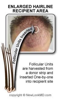 Hair Transplant San Diego - hair transplant in San Diego, CA