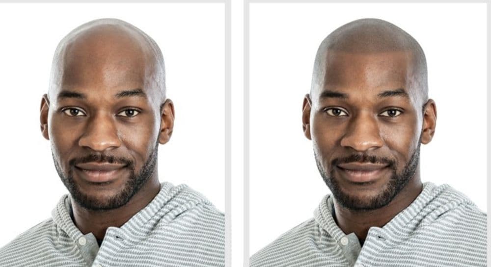 Crown Ink of Atlanta - hair transplant in Atlanta, GA