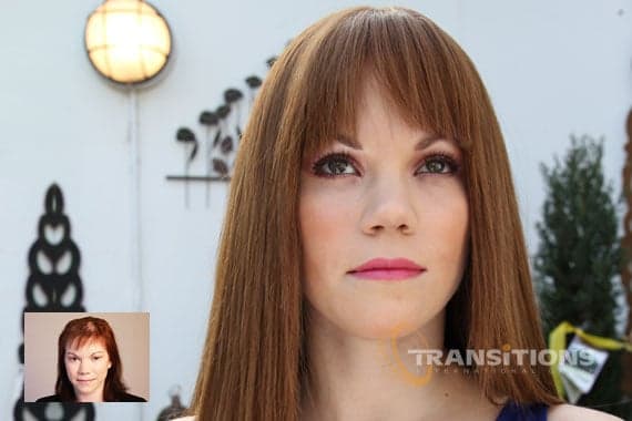 Transitions of Wisconsin - hair transplant in Milwaukee, WI