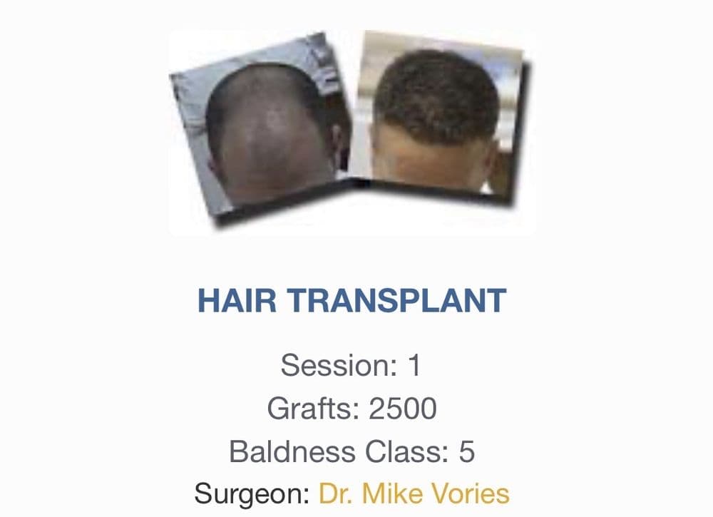 Carolina Hair Surgery - hair transplant in Mount Pleasant, SC