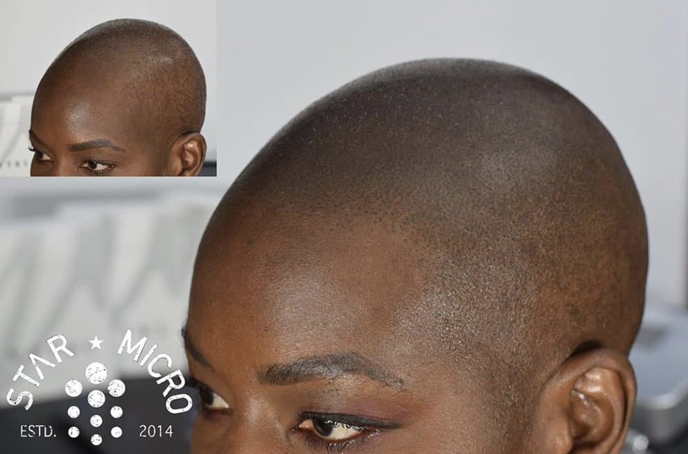 Star Micropigmentation - hair transplant in Tampa, FL