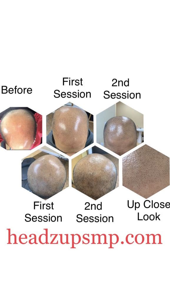Headz Up SMP - hair transplant in Tacoma, WA