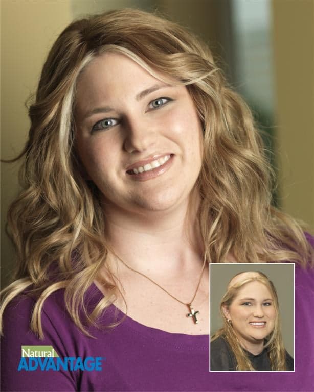 Thinning Hair Solutions - hair transplant in Stamford, CT