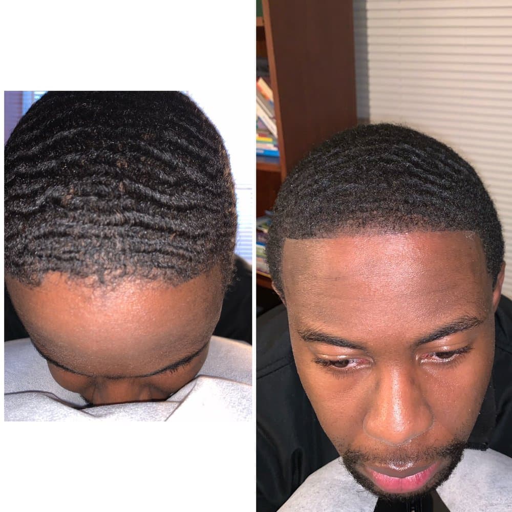 Capital SMP - hair transplant in Washington, DC, DC