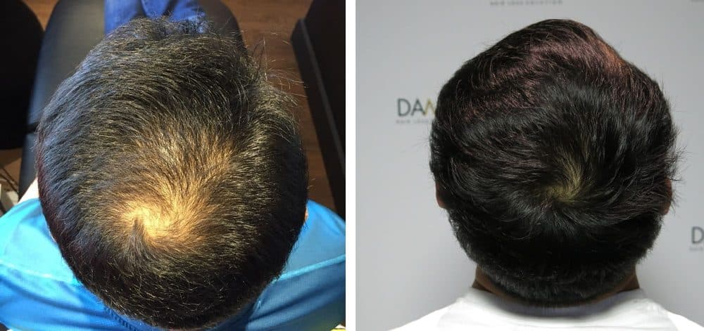 DAMO Hair Loss Clinic - hair transplant in Fort Lee, NJ