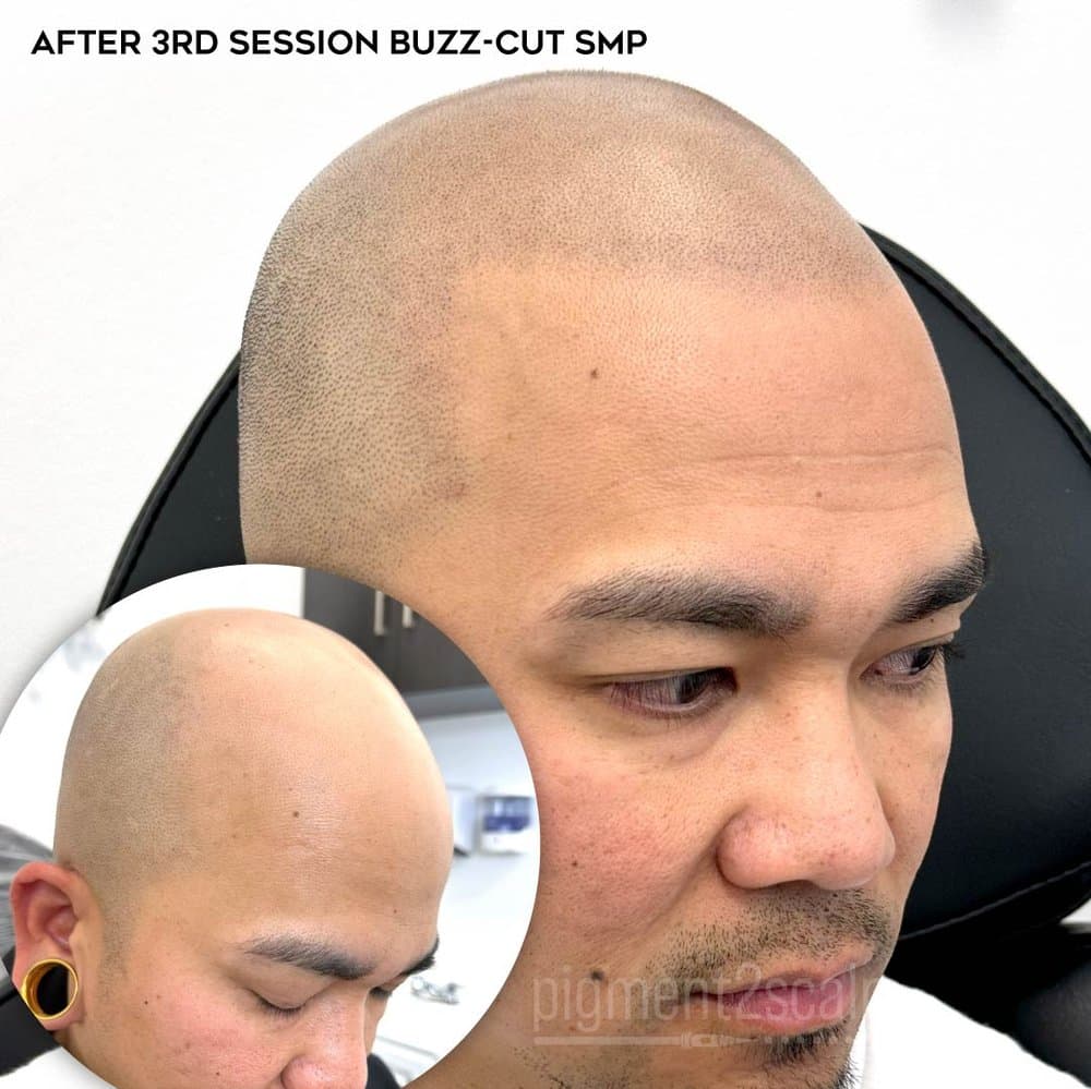 Pigment2scalp Micropigmentation - hair transplant in San Diego, CA