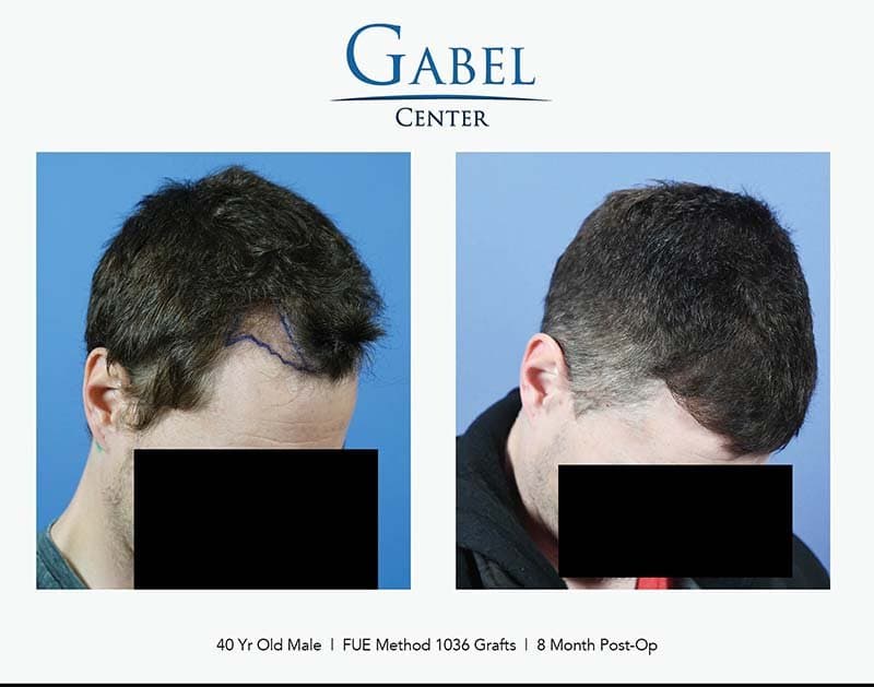 Gabel Center - hair transplant in Portland, OR