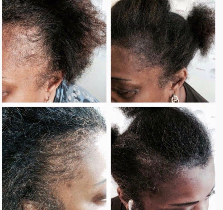 Hairline Time - hair transplant in Culver City, CA