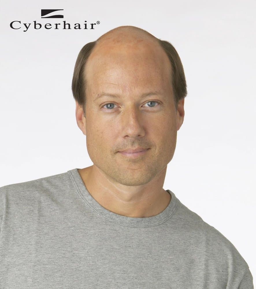 Clarke's Concept - hair transplant in Springfield, IL
