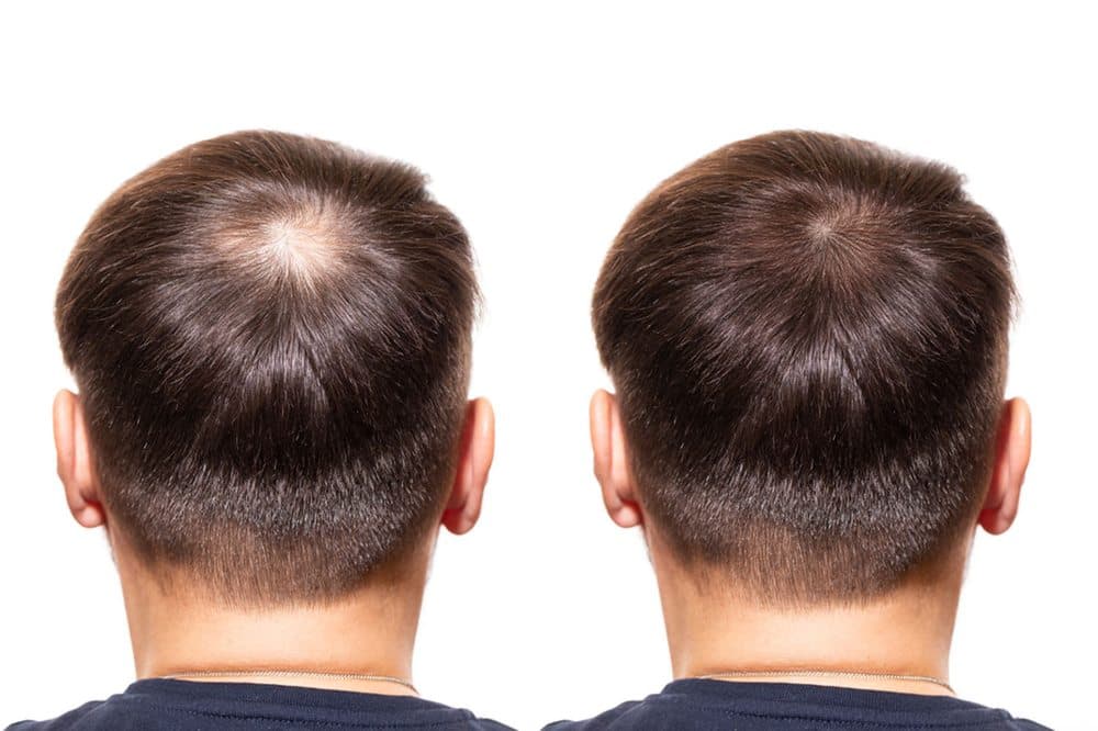 FUE Paradise - hair transplant in Tucson, AZ