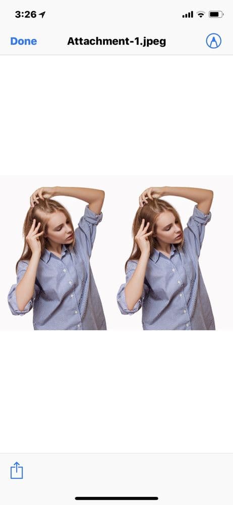 Micro Scalp Design Houston - hair transplant in Houston, TX