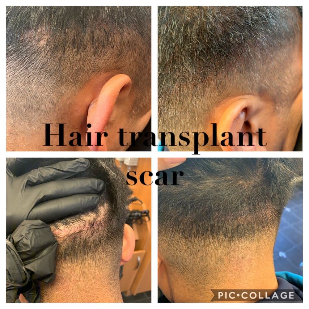 Laser XT - hair transplant in San Francisco, CA