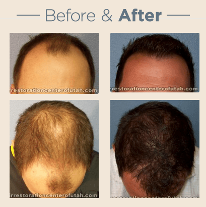 Hair Restoration Center of Utah - hair transplant in Salt Lake City, UT