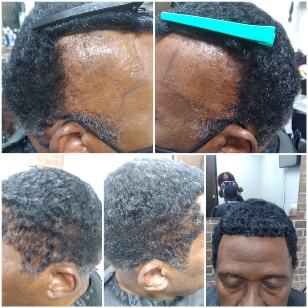 Turners Legacy Creations - hair transplant in Columbia, SC