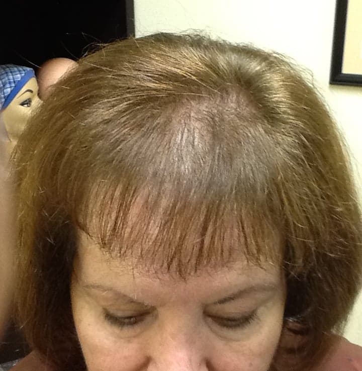 Becky Hair Replacement Specialist - hair transplant in Port Richey, FL