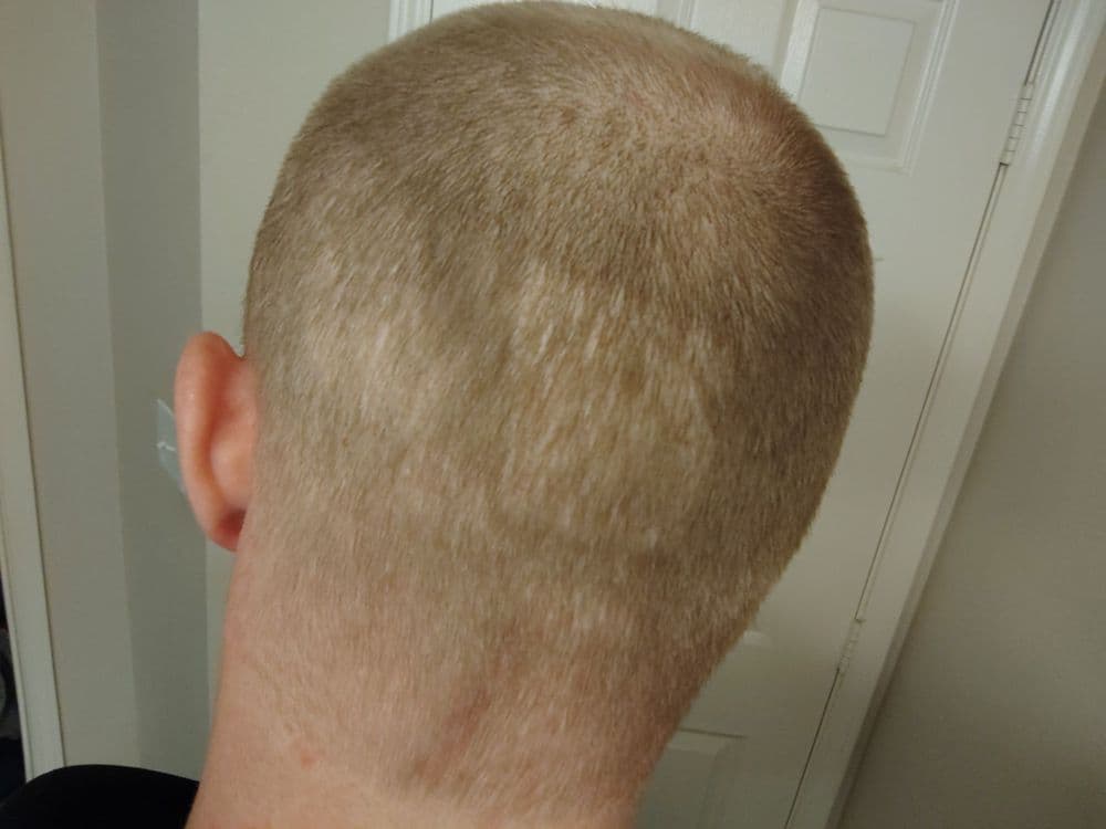 Medical Man cave - hair transplant in Denver, CO