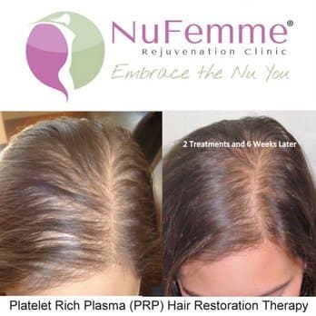 NuFemme Rejuvenation Clinic - Omaha - hair transplant in Omaha, NE
