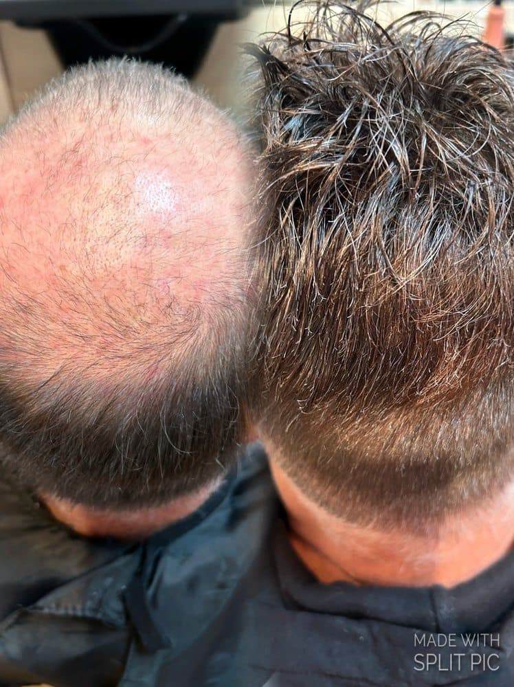 Enhancement Hair Loss Clinic - hair transplant in Creve Coeur, MO