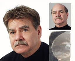 Golden Razor VR Studio - hair transplant in Charlotte, NC