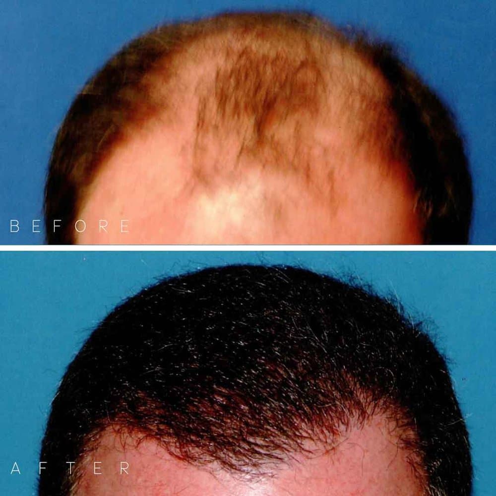 Darling Hair Restoration - hair transplant in Urbandale, IA
