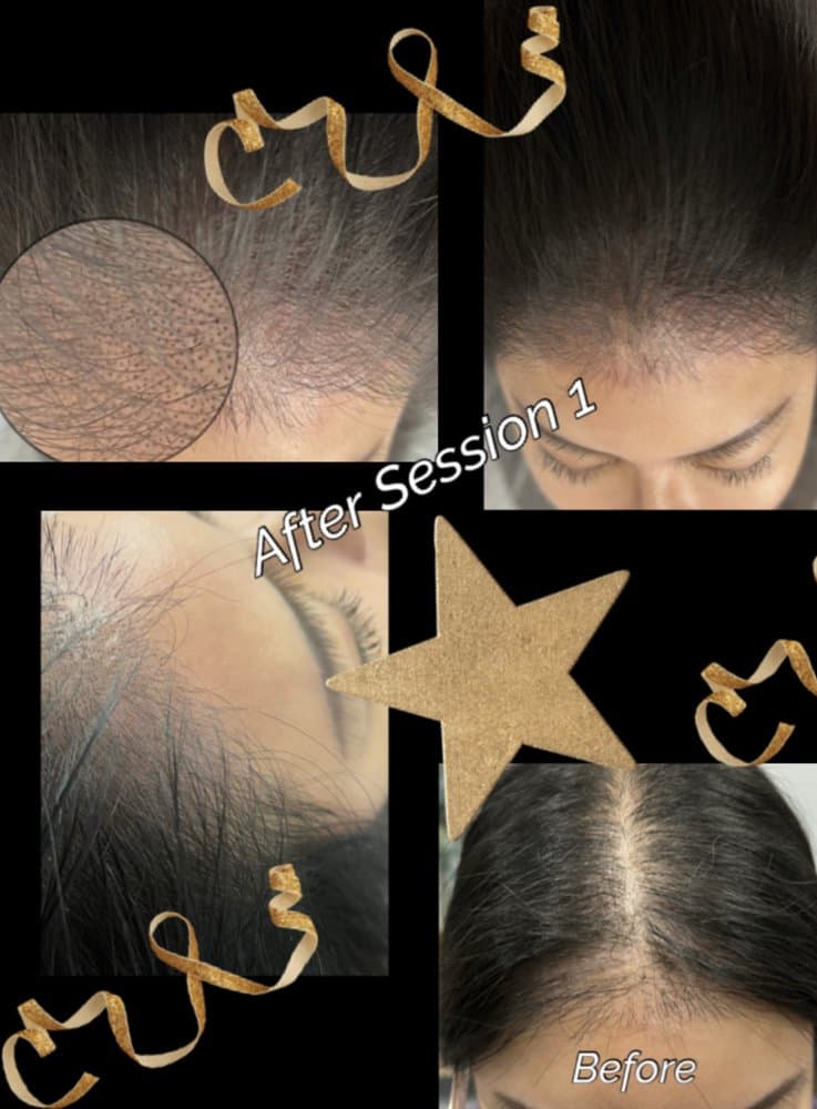 Kintsugi SMP - hair transplant in Fort Wayne, IN