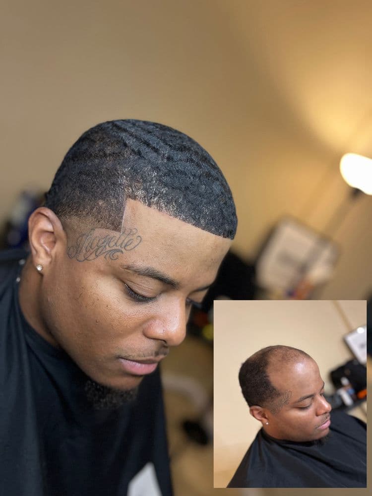 MXL - hair transplant in Philadelphia, PA