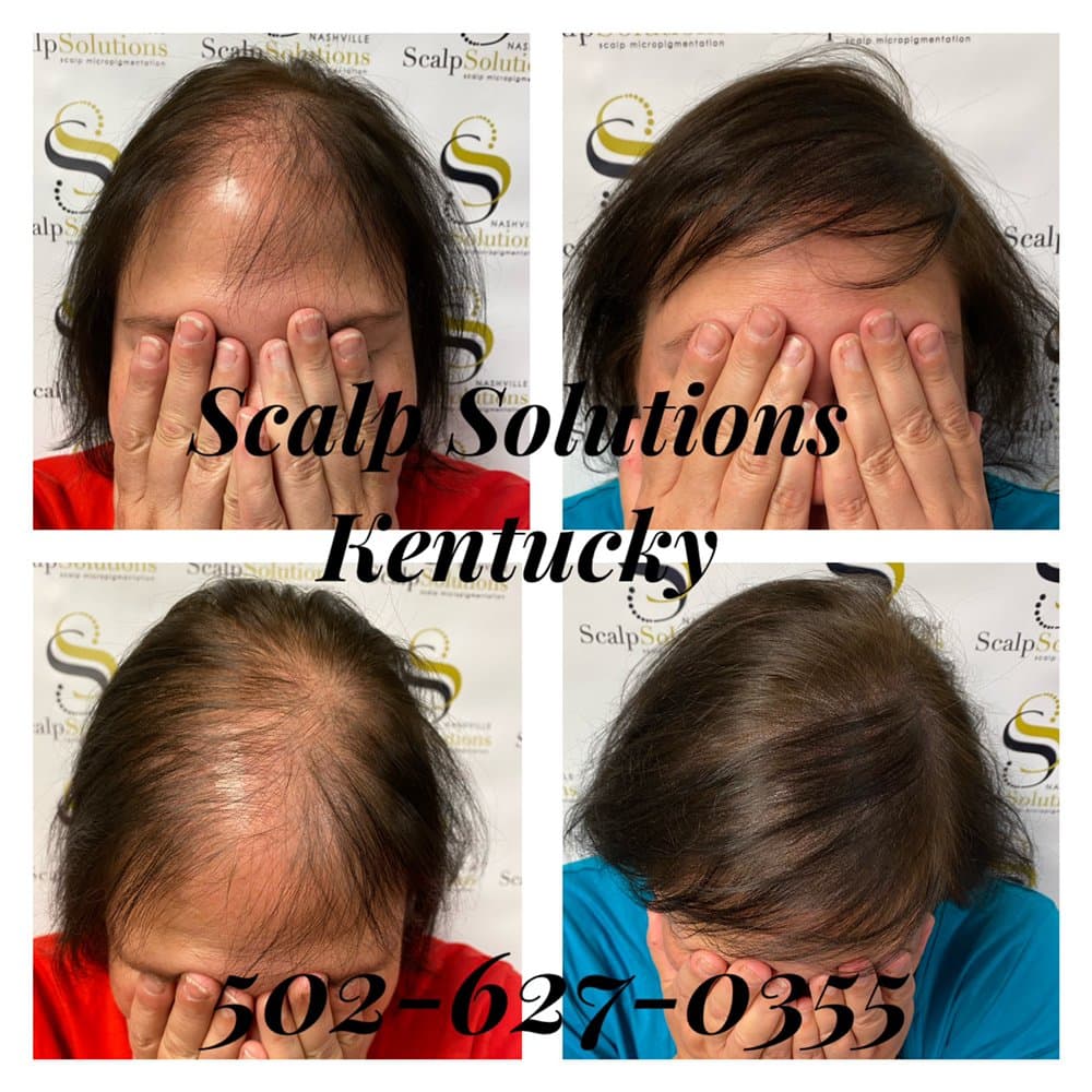 Scalp Solutions Kentucky - hair transplant in Louisville, KY