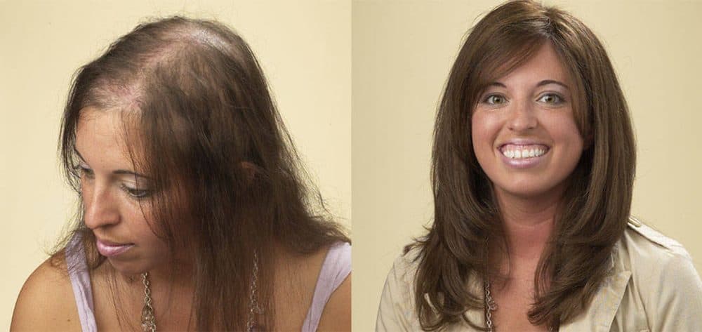 Images International - hair transplant in Dallas, TX