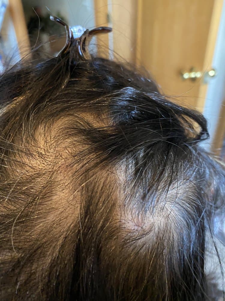 Hair Unlimited of Denver Inc. - hair transplant in Denver, CO