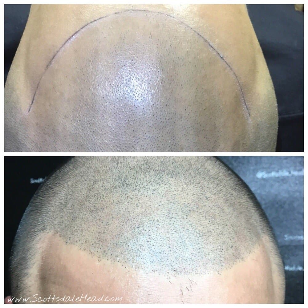 Scottsdale Head - hair transplant in Scottsdale, AZ