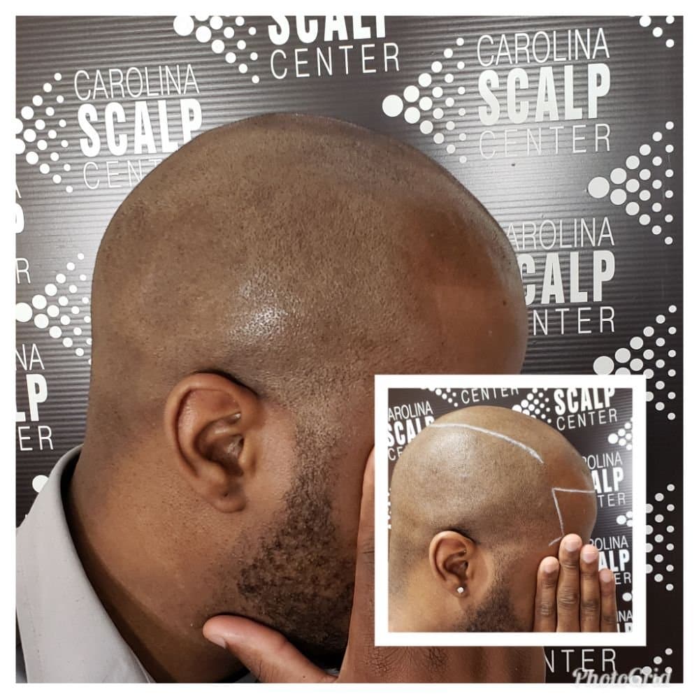 Carolina Scalp Center/Scalp Micropigmentation - hair transplant in Raleigh, NC