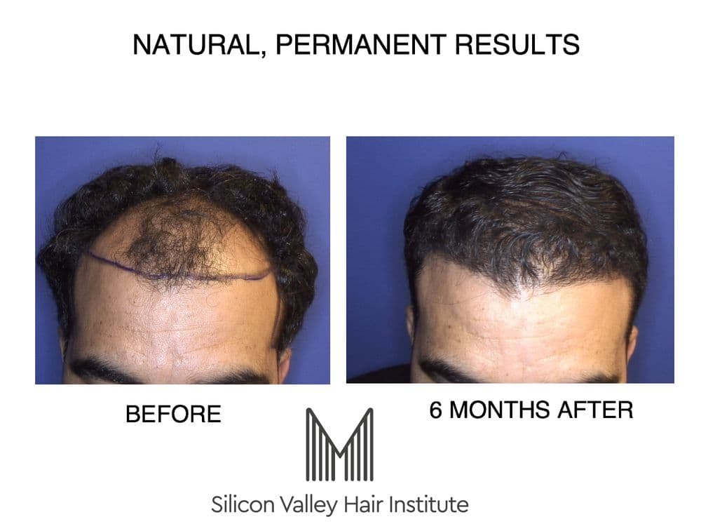 Silicon Valley Hair Institute - hair transplant in Foster City, CA