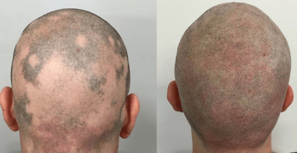 Micro Aesthetics - hair transplant in Boston, MA