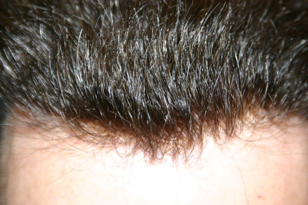 Distinguished Gentleman - hair transplant in Lees Summit, MO