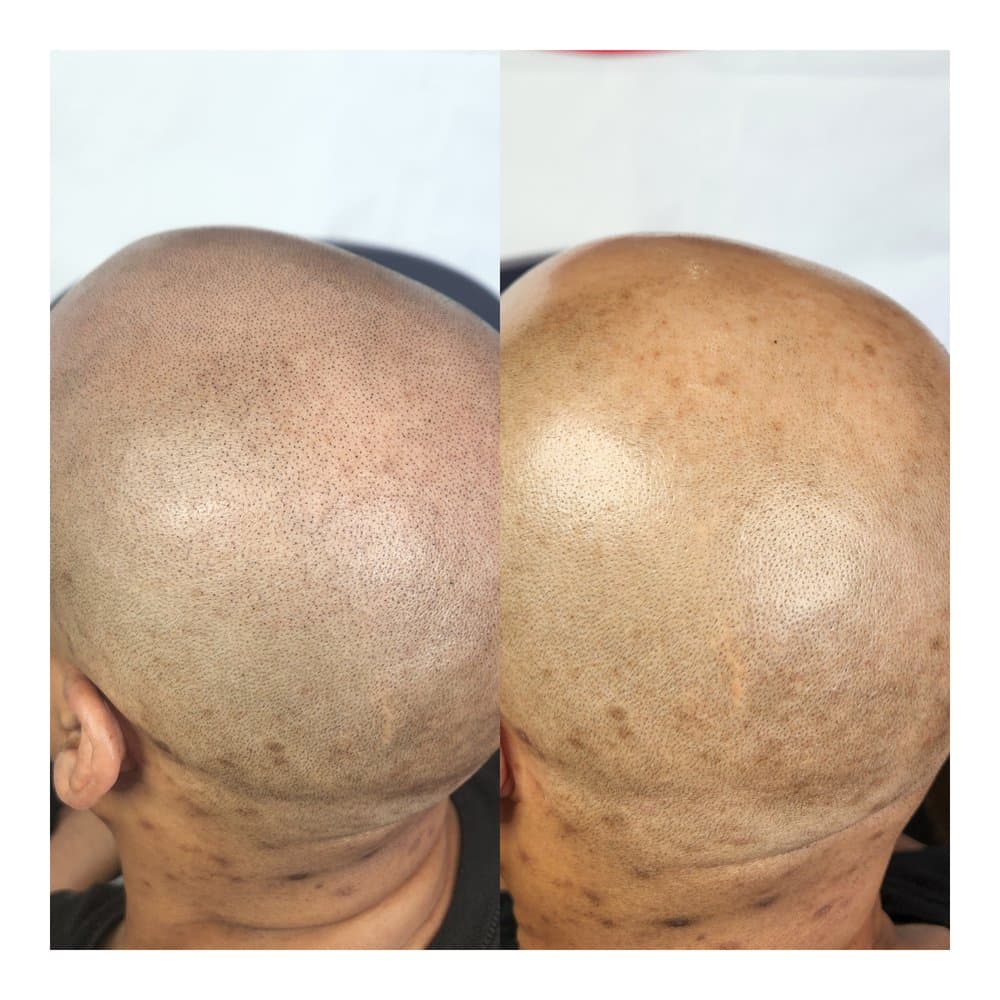 Symmetry Ink Scalp and Beauty - hair transplant in Hudson, MA