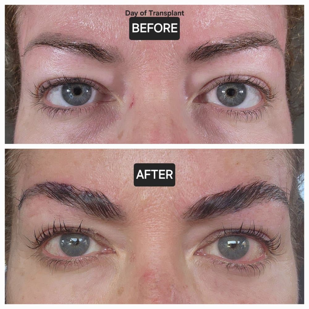 Jernigans Hair Replacement Clinic - hair transplant in Raleigh, NC