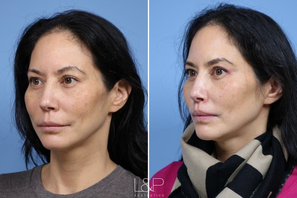 L&P Aesthetics - Los Gatos - hair transplant in Los Gatos, CA