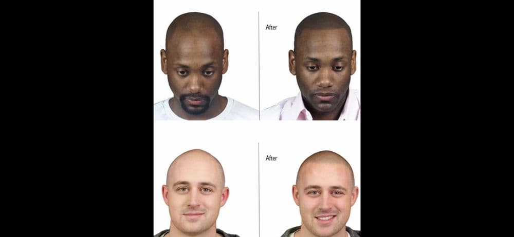 Koelani Banks Hair Where You Want It - hair transplant in Montgomery, AL